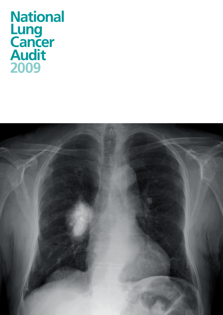 National Lung Cancer Audit 2009