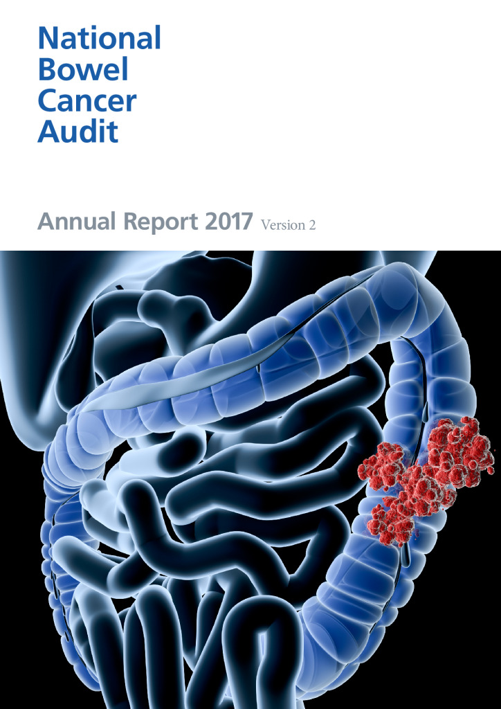 National Bowel Cancer Audit: Annual Report 2017