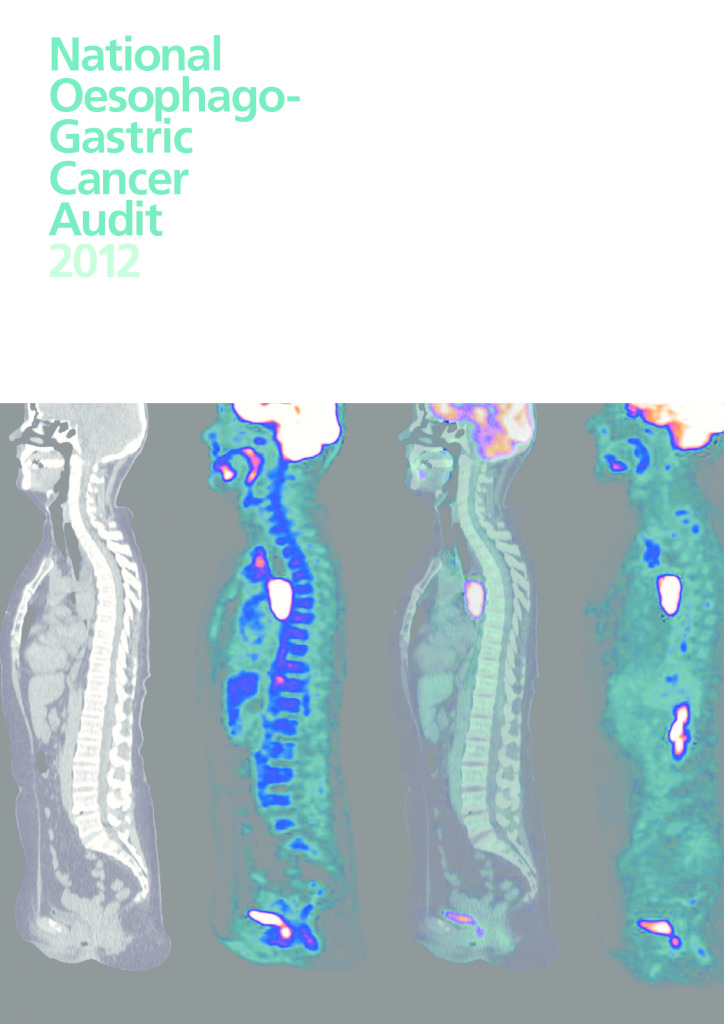 National Oesophago- Gastric Cancer Audit 2012